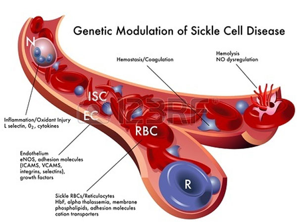 Sickle cell anemia symptoms
