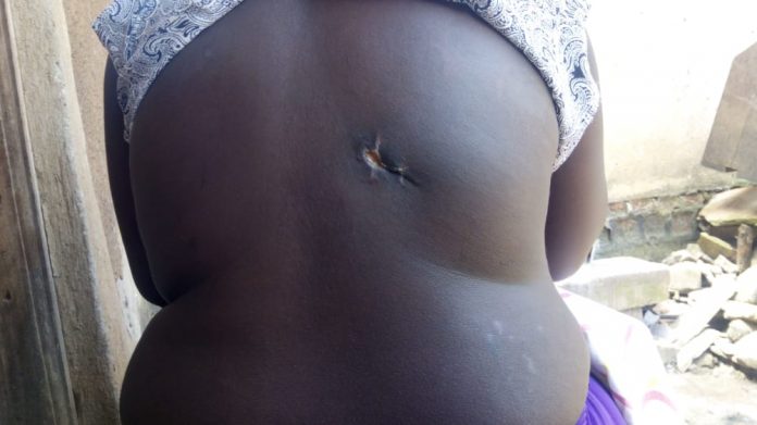 Shakirah Nyemera showing the wound at the back where the bullet came out from.Photo by Ronard Shabomwe.